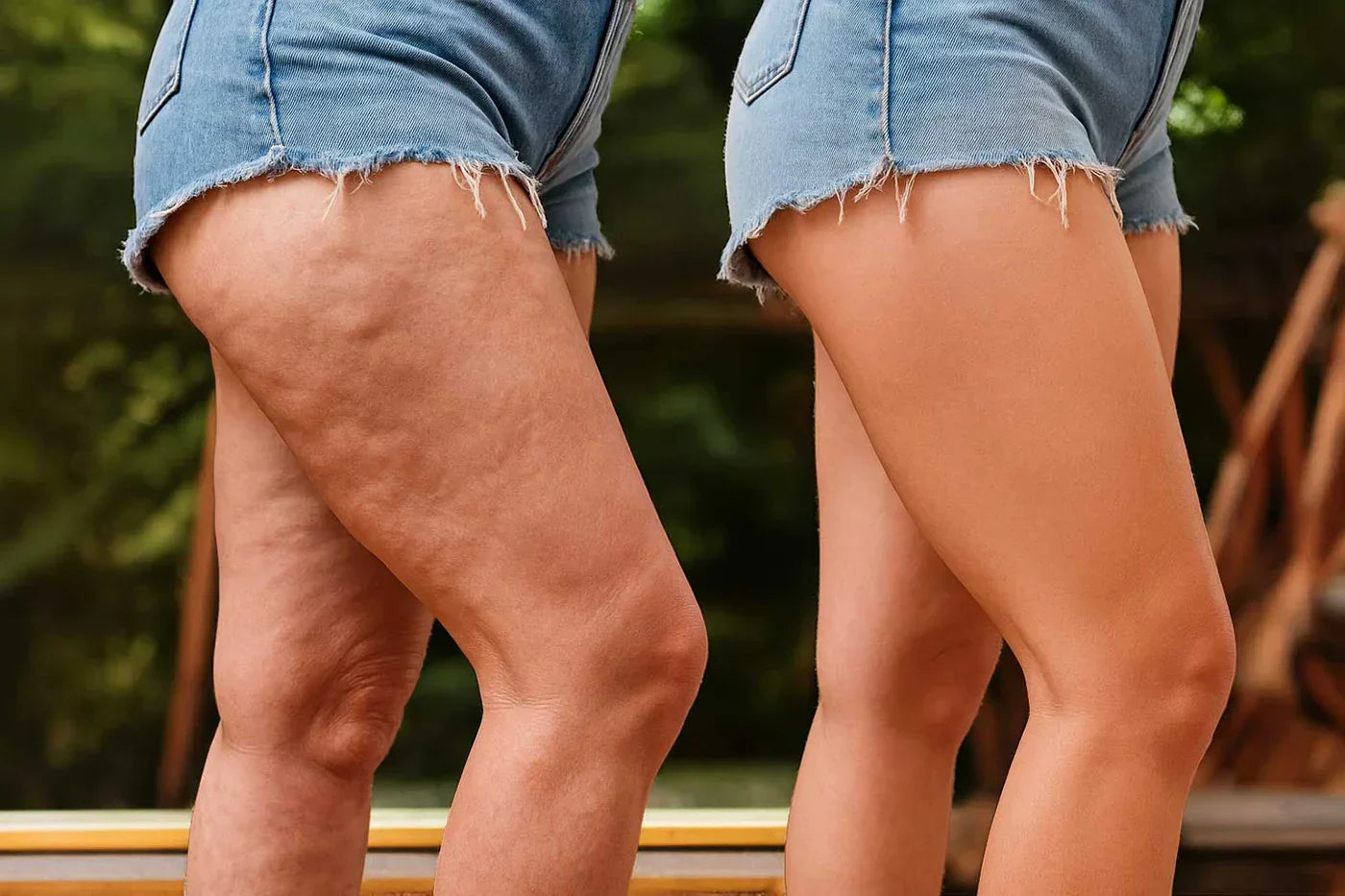 Differenza Cellulite e Ritenzione Idrica: Cause e Rimedi